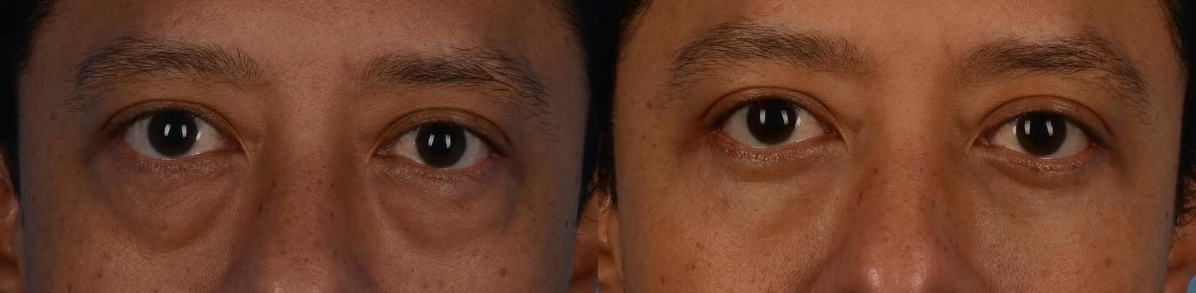 Before & After Blepharoplasty Case 326 Front View in Toronto, ON