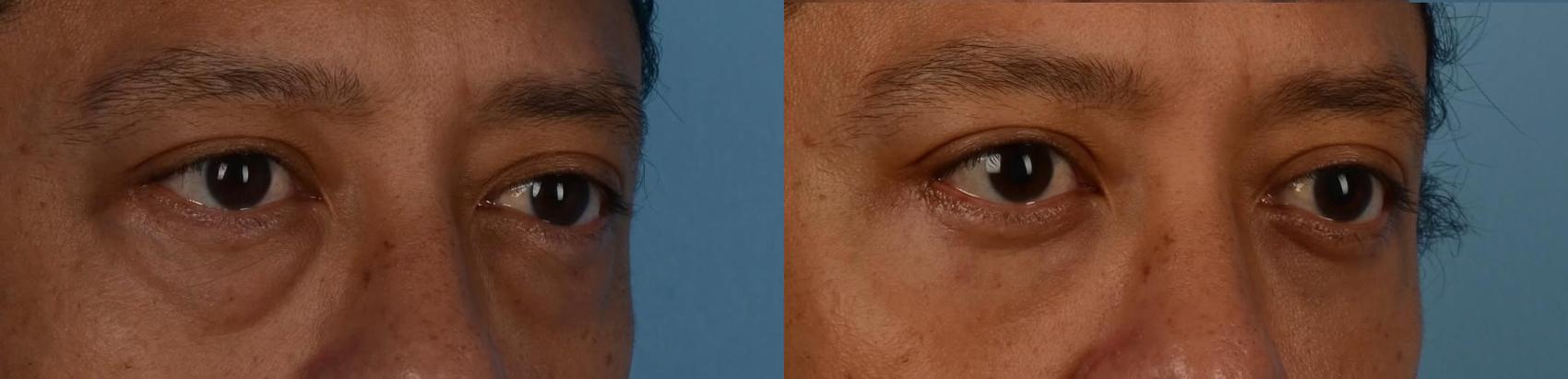 Before & After Blepharoplasty Case 326 Right Side View in Toronto, ON