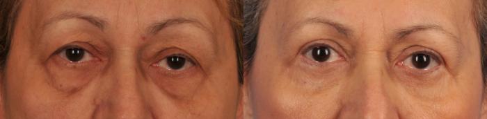 Before & After Blepharoplasty Case 33 View #1 View in Toronto, ON