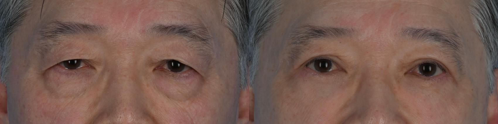 Before & After Blepharoplasty Case 333 Front View in Toronto, ON