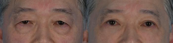 Before & After Blepharoplasty Case 333 Front View in Toronto, ON