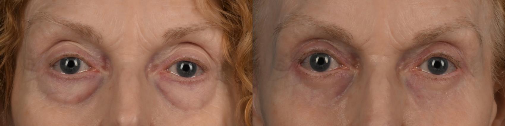 Before & After Blepharoplasty Case 335 Front View in Toronto, ON