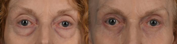 Before & After Blepharoplasty Case 335 Front View in Toronto, ON