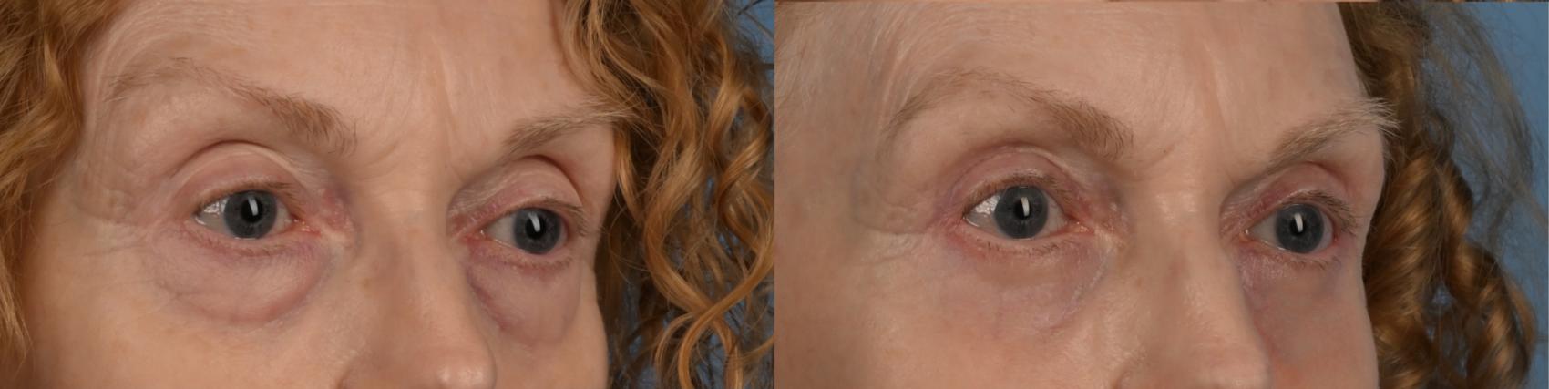 Before & After Blepharoplasty Case 335 Left Oblique View in Toronto, ON