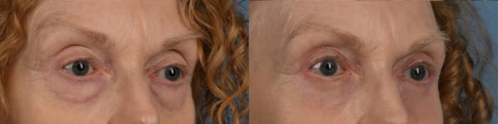Before & After Blepharoplasty Case 335 Left Oblique View in Toronto, ON