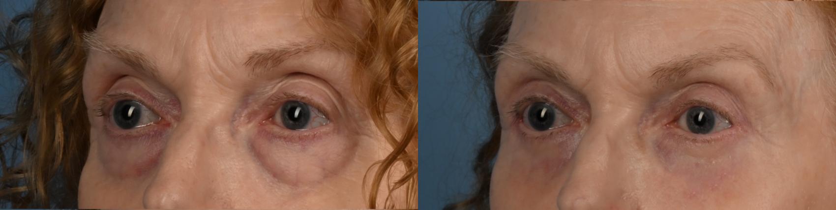 Before & After Blepharoplasty Case 335 Right Oblique View in Toronto, ON