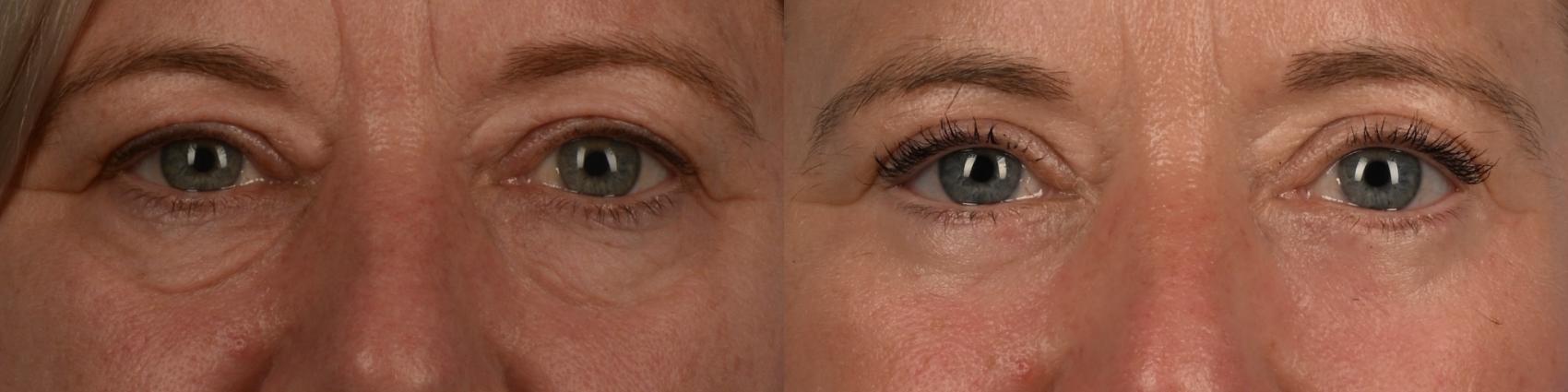 Before & After Blepharoplasty Case 336 Front View in Toronto, ON