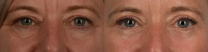 Before & After Blepharoplasty Case 336 Front View in Toronto, ON