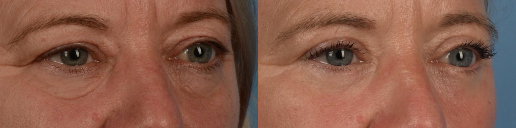 Before & After Blepharoplasty Case 336 Left Oblique View in Toronto, ON