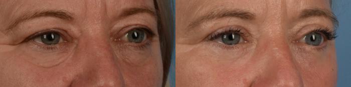 Before & After Blepharoplasty Case 336 Left Oblique View in Toronto, ON