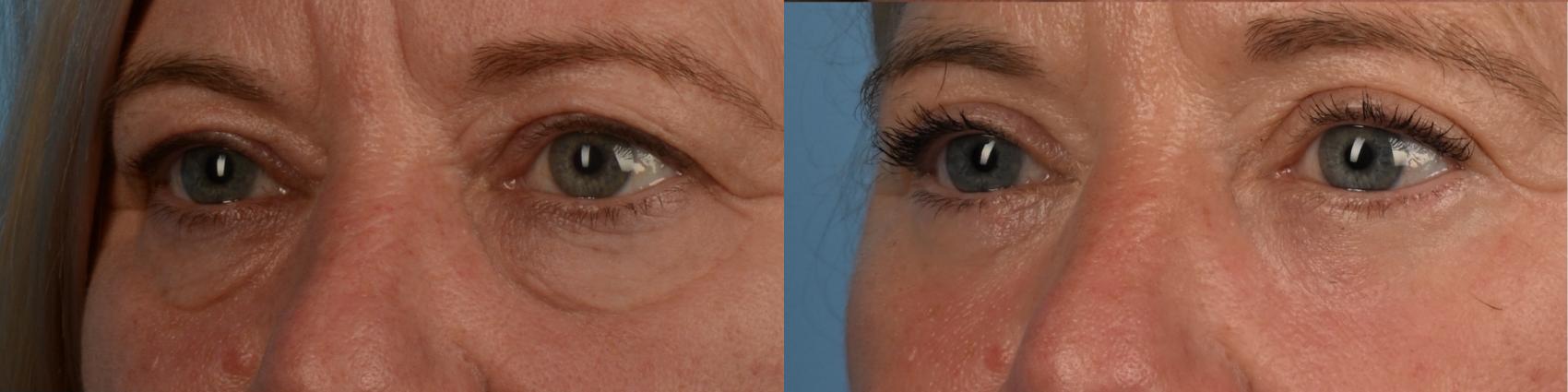 Before & After Blepharoplasty Case 336 Right Oblique View in Toronto, ON