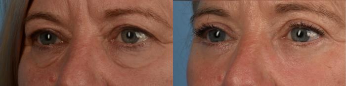 Before & After Blepharoplasty Case 336 Right Oblique View in Toronto, ON