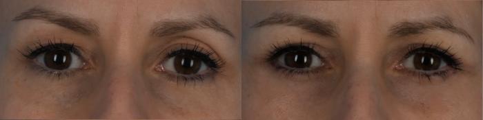 Before & After Blepharoplasty Case 339 Front View in Toronto, ON