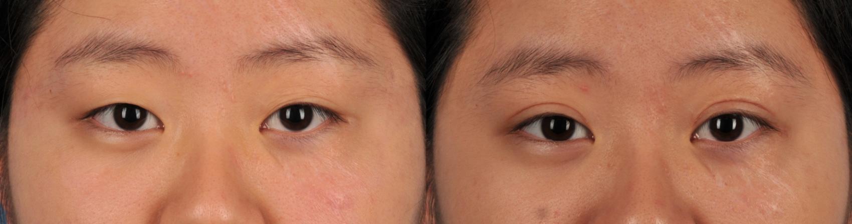 Before & After Blepharoplasty Case 40 View #1 View in Toronto, ON