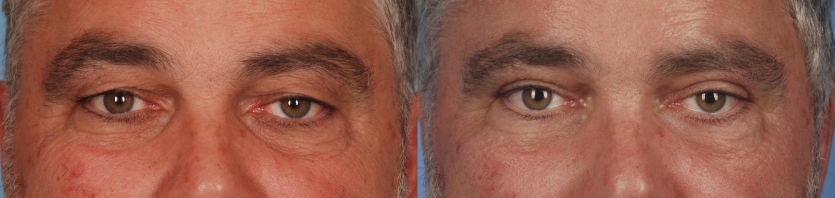 Before & After Blepharoplasty Case 41 View #1 View in Toronto, ON
