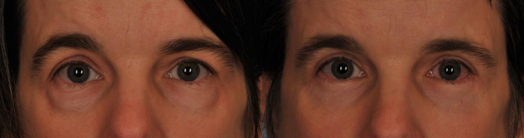 Before & After Blepharoplasty Case 42 View #1 View in Toronto, ON