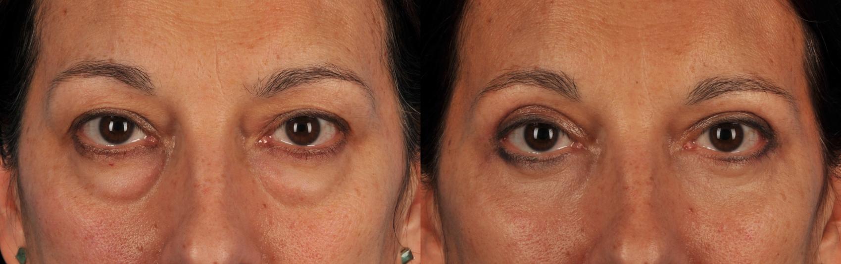 Before & After Blepharoplasty Case 43 View #1 View in Toronto, ON