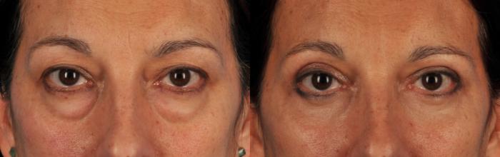 Before & After Blepharoplasty Case 43 View #1 View in Toronto, ON