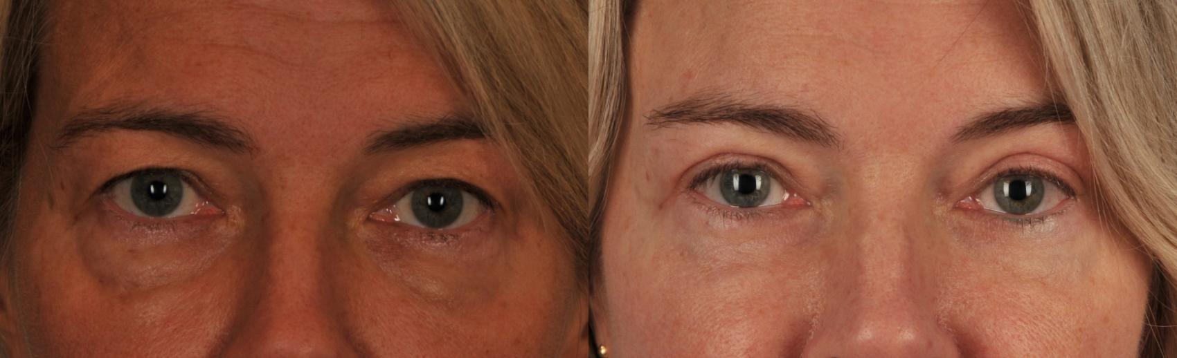Before & After Blepharoplasty Case 47 View #1 View in Toronto, ON