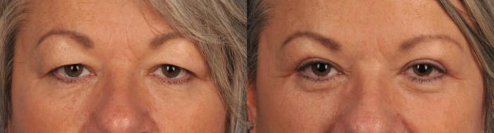 Before & After Blepharoplasty Case 48 View #1 View in Toronto, ON