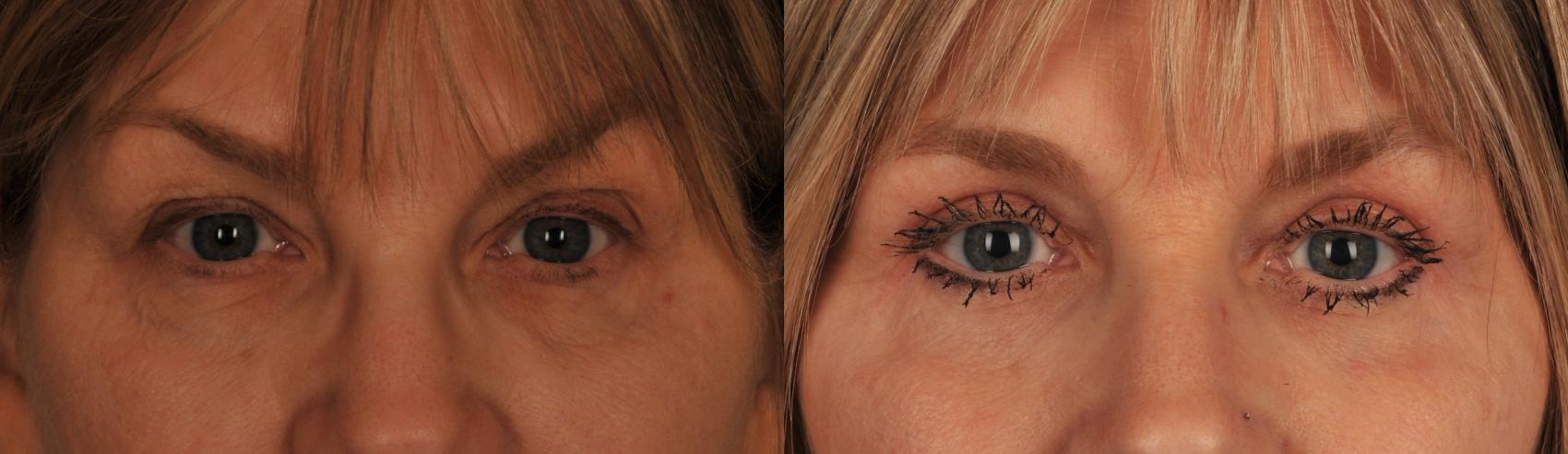 Before & After Blepharoplasty Case 53 View #1 View in Toronto, ON