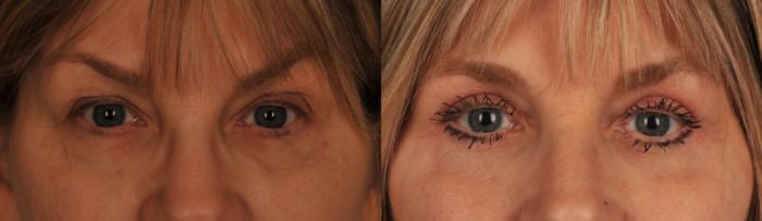 Before & After Blepharoplasty Case 53 View #1 View in Toronto, ON
