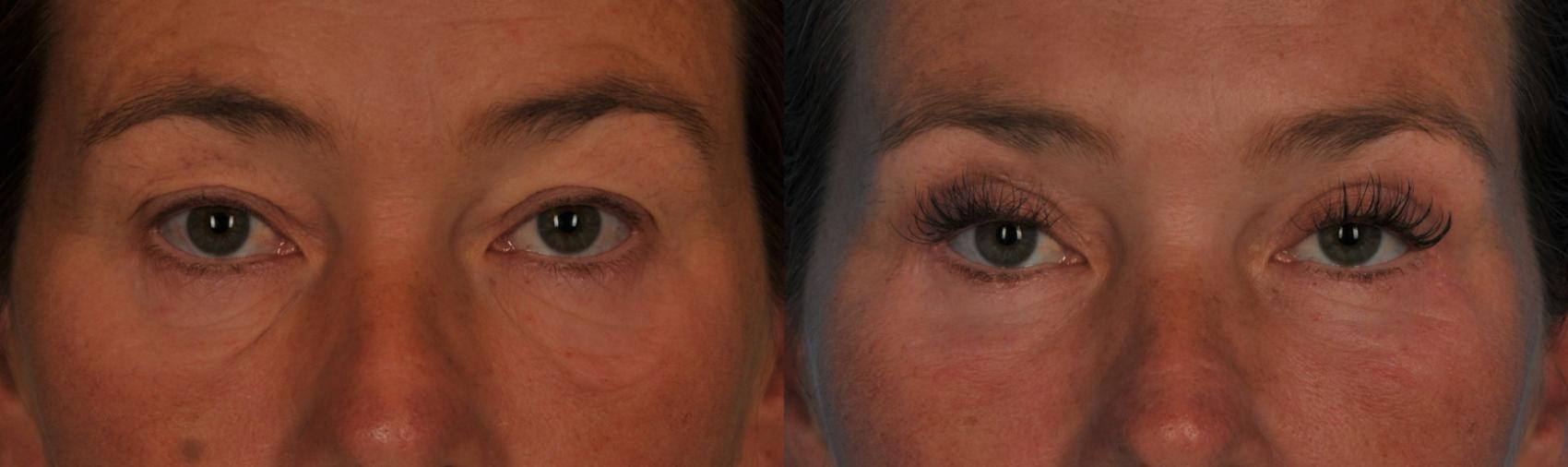 Before & After Blepharoplasty Case 78 View #1 View in Toronto, ON