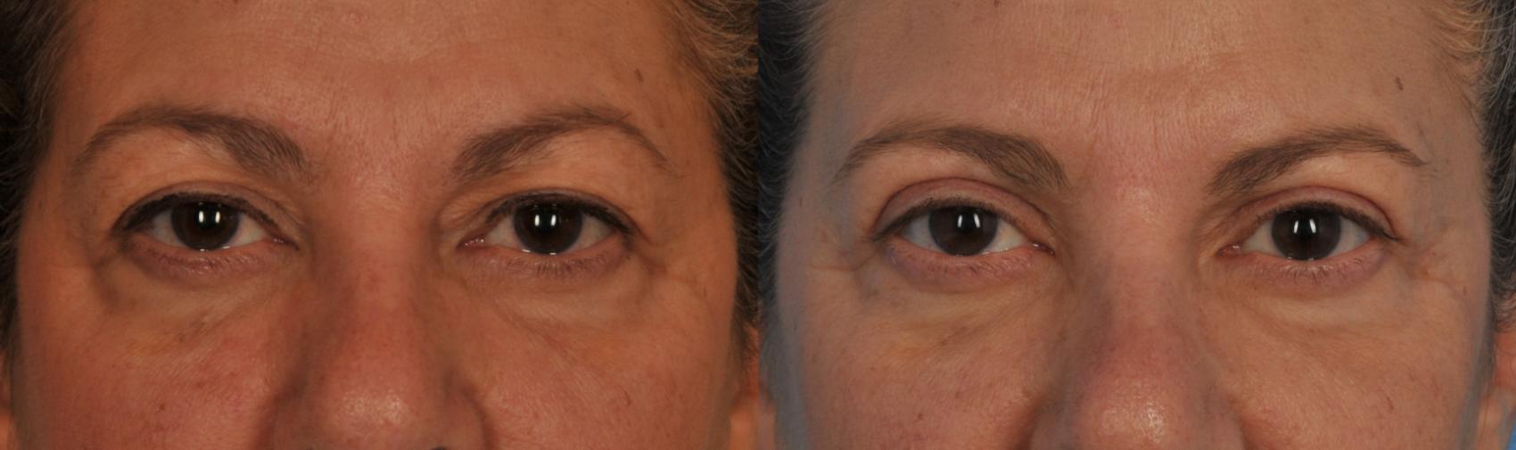 Before & After Blepharoplasty Case 79 View #1 View in Toronto, ON