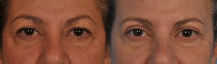 Before & After Blepharoplasty Case 79 View #1 View in Toronto, ON