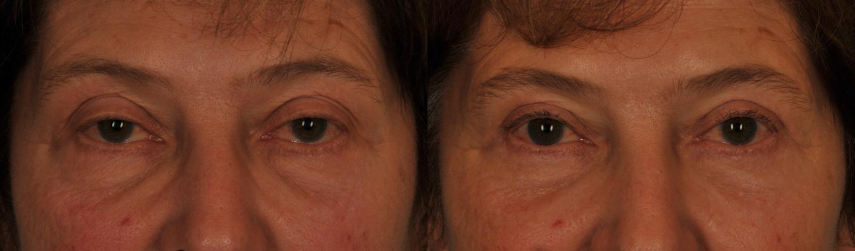 Before & After Blepharoplasty Case 80 View #1 View in Toronto, ON