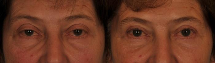 Before & After Blepharoplasty Case 80 View #1 View in Toronto, ON