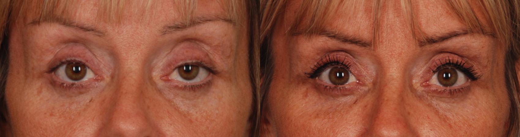 Before & After Blepharoplasty Case 84 View #1 View in Toronto, ON