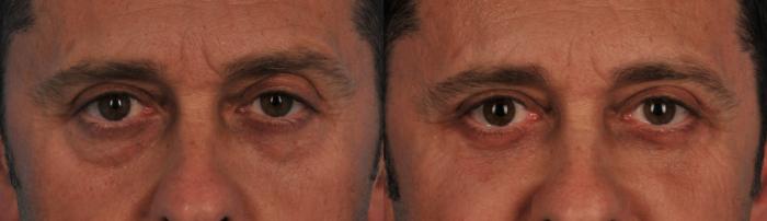 Before & After Blepharoplasty Case 86 View #1 View in Toronto, ON