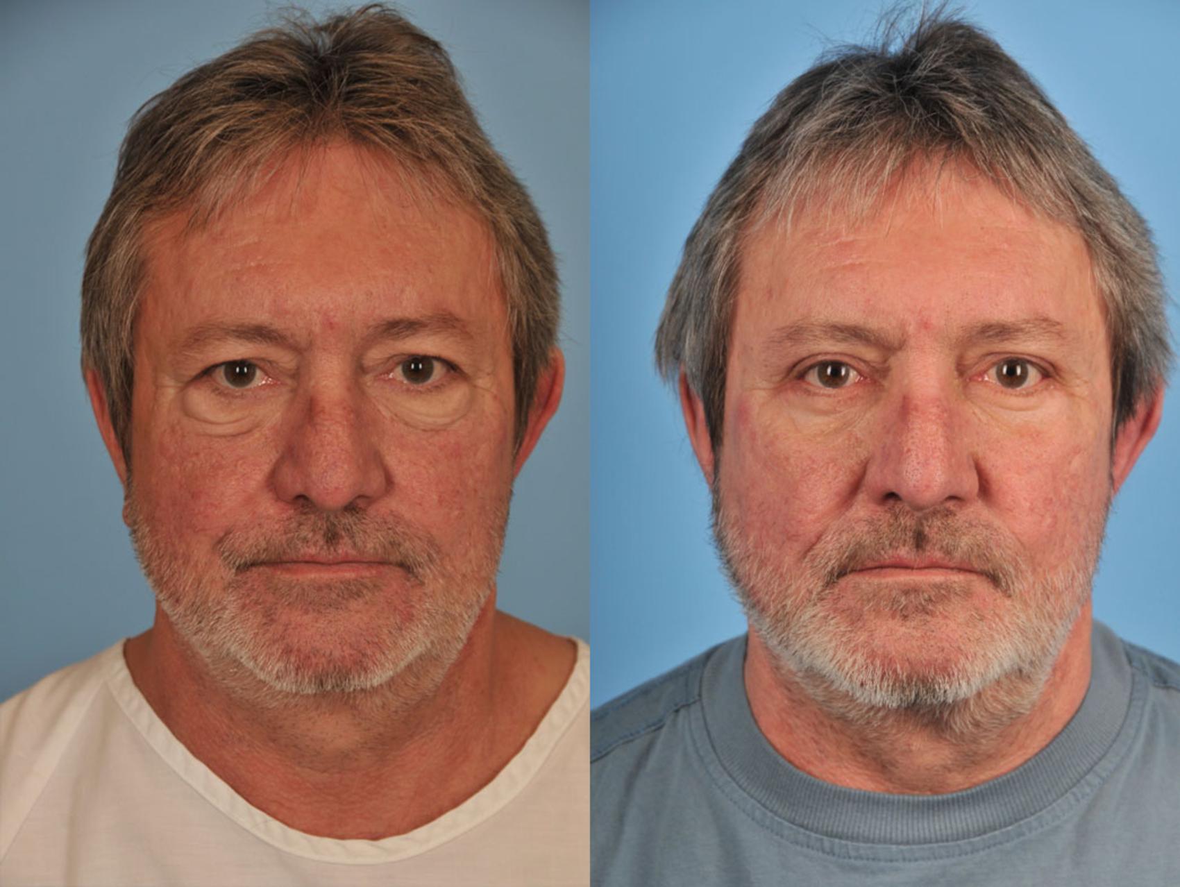 Before & After Blepharoplasty Case 9 View #1 View in Toronto, ON