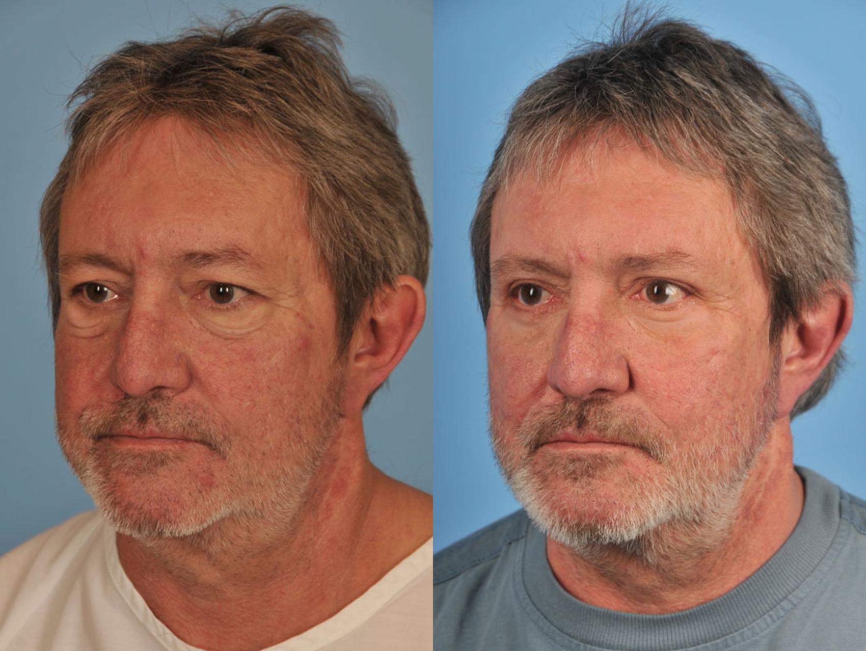 Before & After Blepharoplasty Case 9 View #2 View in Toronto, ON