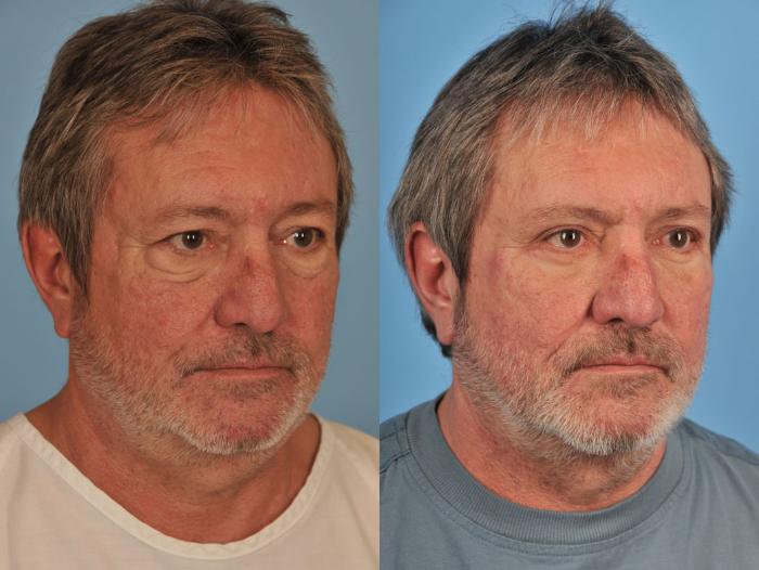 Before & After Blepharoplasty Case 9 View #3 View in Toronto, ON