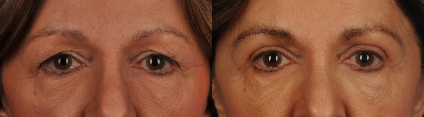 Before & After Blepharoplasty Case 91 View #1 View in Toronto, ON