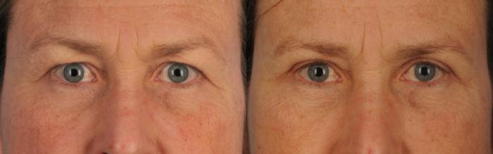 Before & After Blepharoplasty Case 92 View #1 View in Toronto, ON