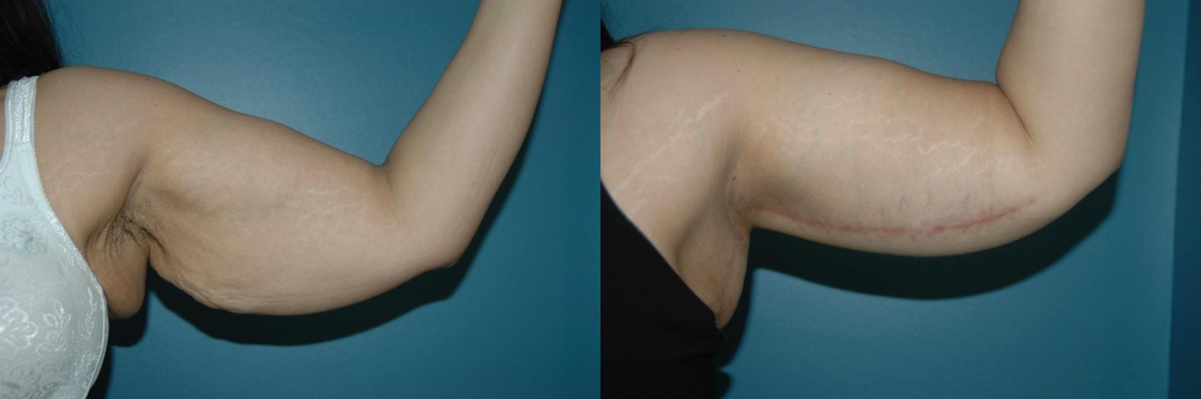 Before & After Brachioplasty Case 31 View #1 View in Toronto, ON