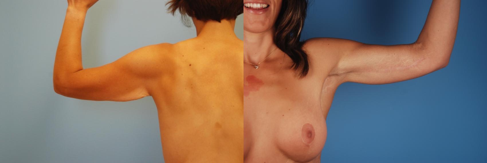 Before & After Brachioplasty Case 32 View #1 View in Toronto, ON
