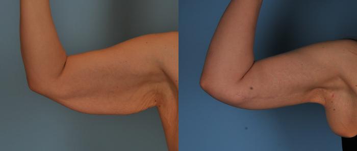 Before & After Brachioplasty Case 87 View #1 View in Toronto, ON