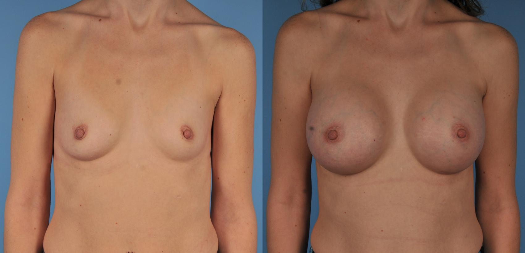 Before & After Breast Augmentation Case 101 View #1 View in Toronto, ON