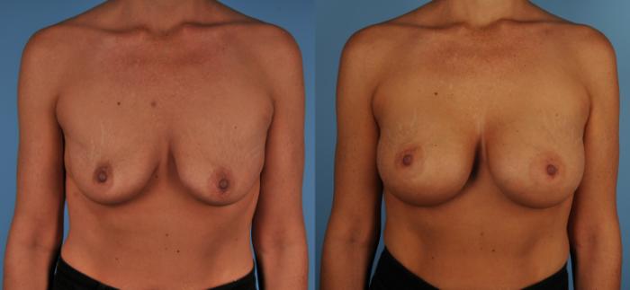 Before & After Breast Augmentation Case 102 View #1 View in Toronto, ON