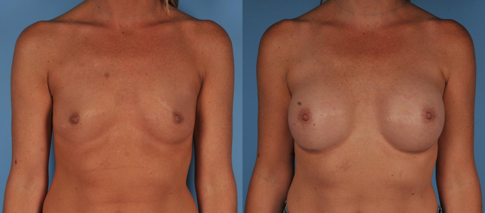 Before & After Breast Augmentation Case 103 View #1 View in Toronto, ON