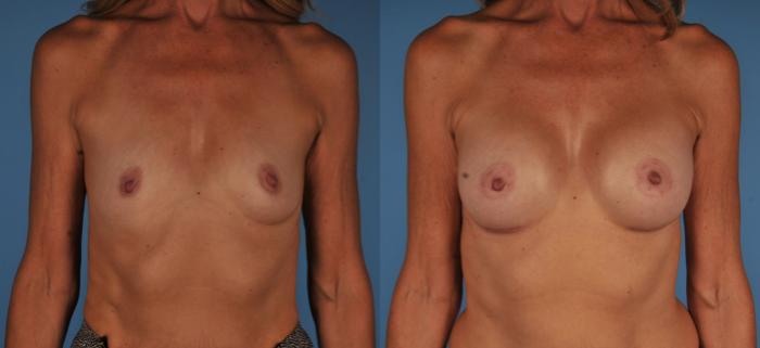 Before & After Breast Augmentation Case 104 View #1 View in Toronto, ON