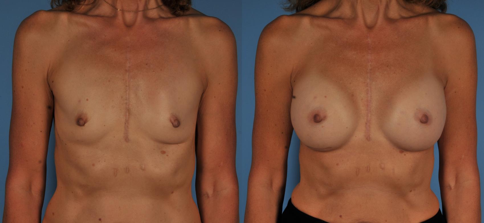 Before & After Breast Augmentation Case 109 View #1 View in Toronto, ON