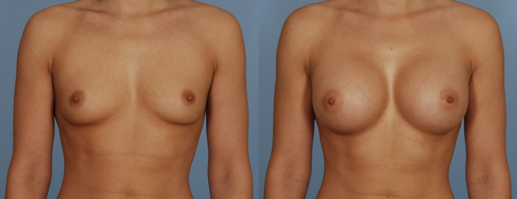 Before & After Breast Augmentation Case 113 View #1 View in Toronto, ON