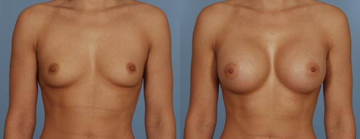 Before & After Breast Augmentation Case 113 View #1 View in Toronto, ON