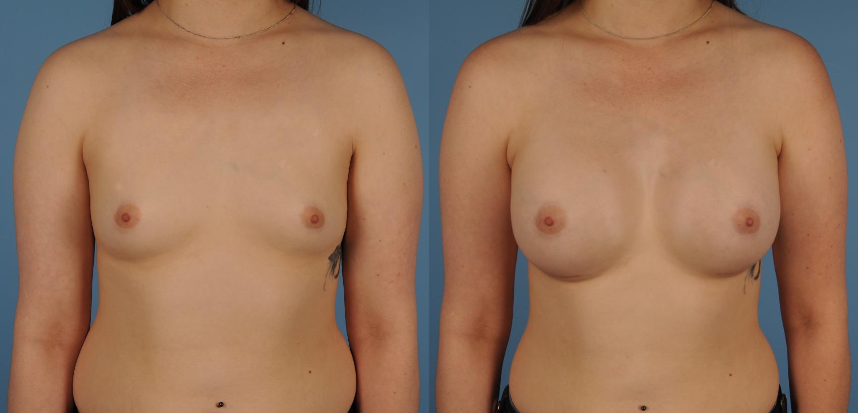 Before & After Breast Augmentation Case 134 View #1 View in Toronto, ON