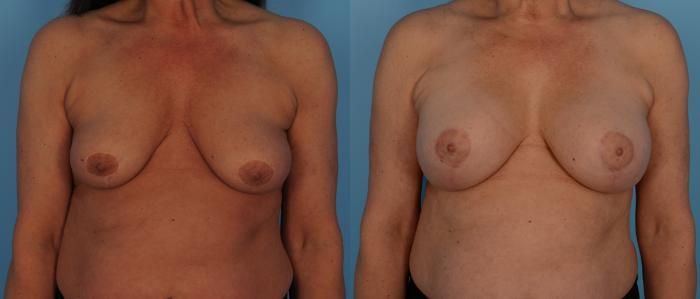 Before & After Breast Augmentation Case 142 View #1 View in Toronto, ON